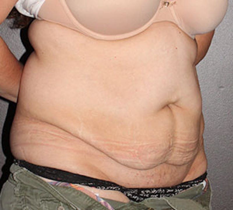 Abdominoplasty (Tummy Tuck) Before & After Gallery - Patient 117645905 - Image 3