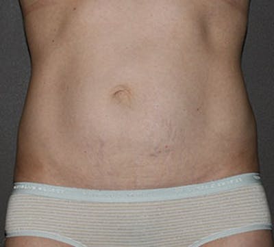 Abdominoplasty (Tummy Tuck) Before & After Gallery - Patient 117645906 - Image 1