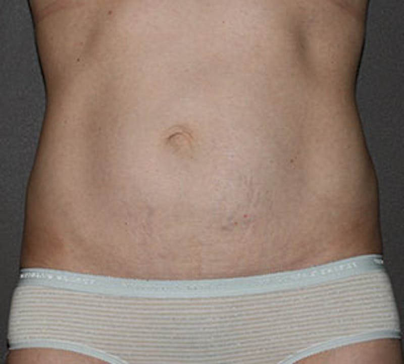 Abdominoplasty (Tummy Tuck) Before & After Gallery - Patient 117645906 - Image 1