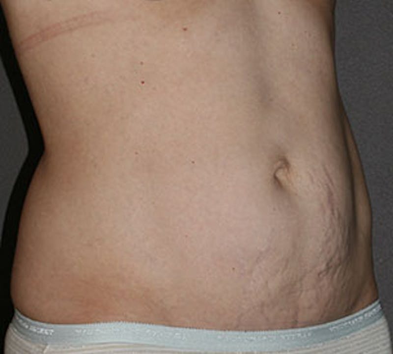 Abdominoplasty (Tummy Tuck) Before & After Gallery - Patient 117645906 - Image 3