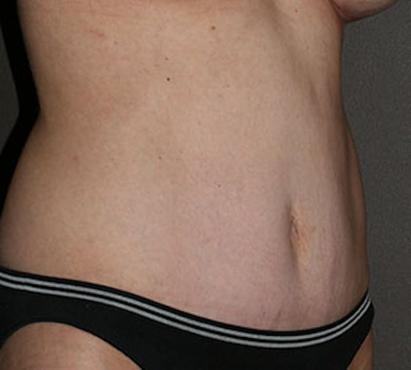 Abdominoplasty (Tummy Tuck) Before & After Gallery - Patient 117645906 - Image 4