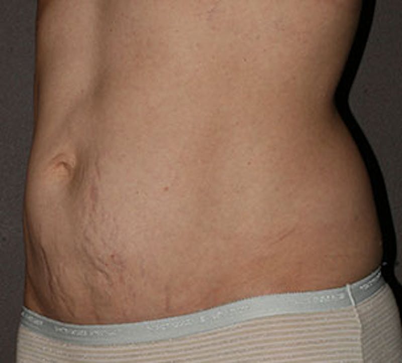 Abdominoplasty (Tummy Tuck) Before & After Gallery - Patient 117645906 - Image 5
