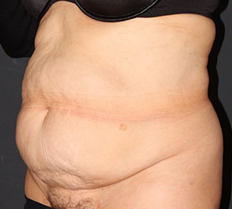Abdominoplasty (Tummy Tuck) Before & After Gallery - Patient 117645907 - Image 5