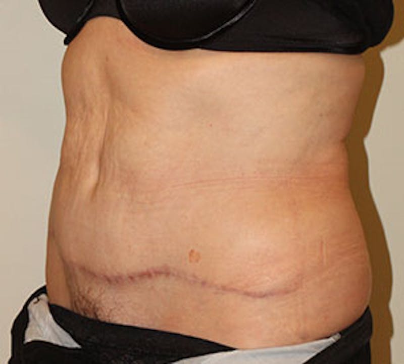 Abdominoplasty (Tummy Tuck) Before & After Gallery - Patient 117645907 - Image 6