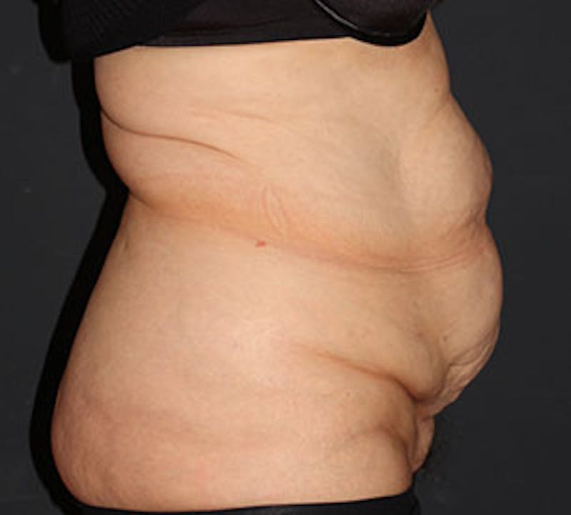 Abdominoplasty (Tummy Tuck) Before & After Gallery - Patient 117645907 - Image 7