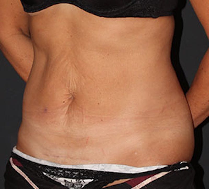 Abdominoplasty (Tummy Tuck) Before & After Gallery - Patient 117645908 - Image 5