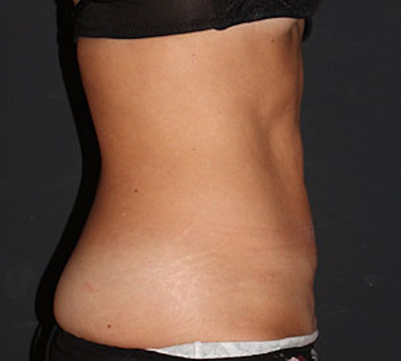 Abdominoplasty (Tummy Tuck) Before & After Gallery - Patient 117645908 - Image 7