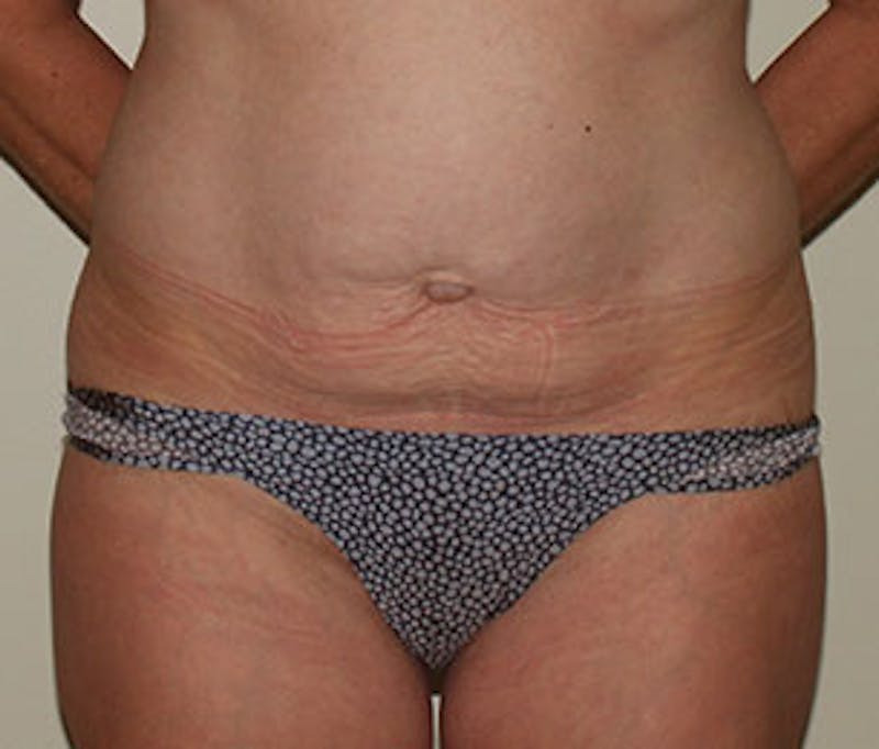 Mommy Makeover Before & After Gallery - Patient 117645915 - Image 3