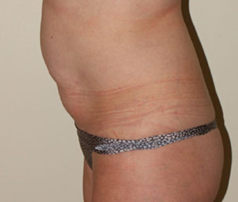 Mommy Makeover Before & After Gallery - Patient 117645915 - Image 19