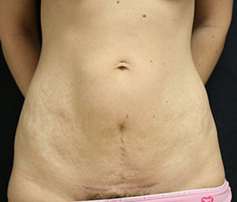 Mommy Makeover Before & After Gallery - Patient 117645916 - Image 3