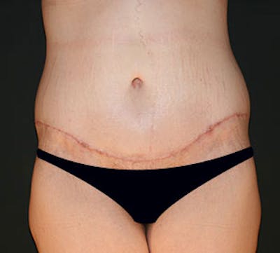 After Weight Loss Gallery - Patient 117645919 - Image 2