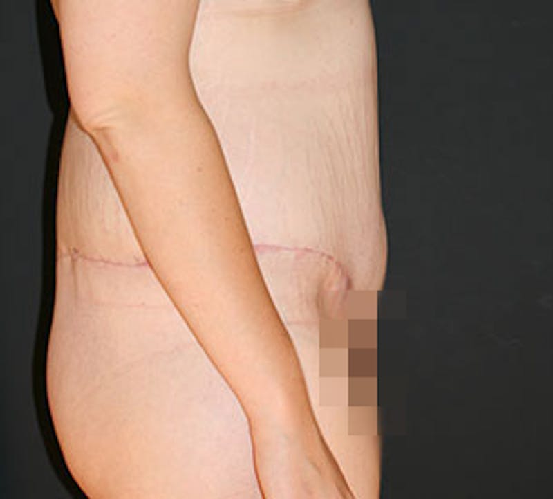 After Weight Loss Before & After Gallery - Patient 117645919 - Image 4