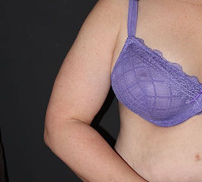 After Weight Loss Before & After Gallery - Patient 117645921 - Image 2