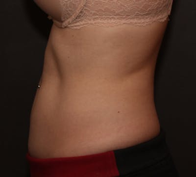 CoolSculpting® Before & After Gallery - Patient 117645933 - Image 2