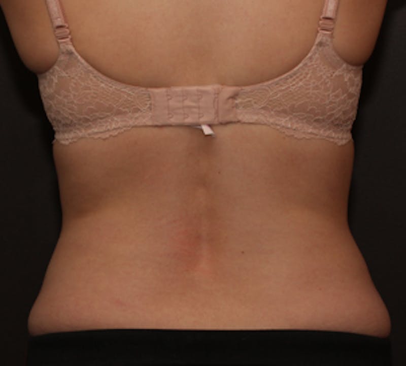 CoolSculpting® Before & After Gallery - Patient 117645933 - Image 4