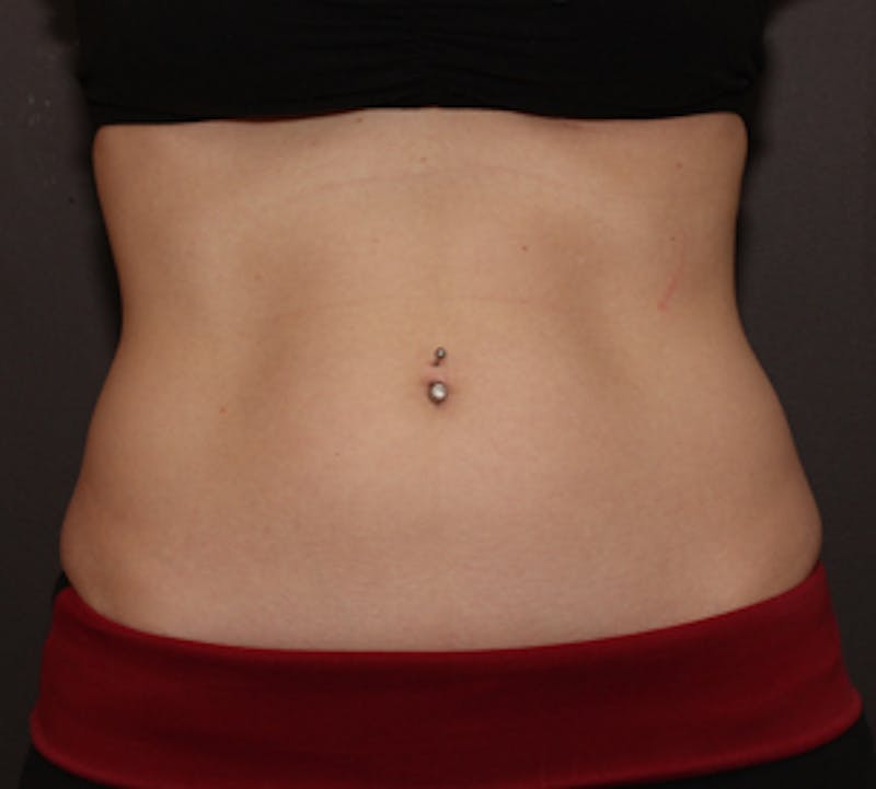 CoolSculpting® Before & After Gallery - Patient 117645933 - Image 5