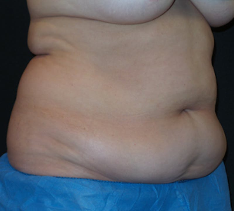 CoolSculpting® Before & After Gallery - Patient 117645935 - Image 3