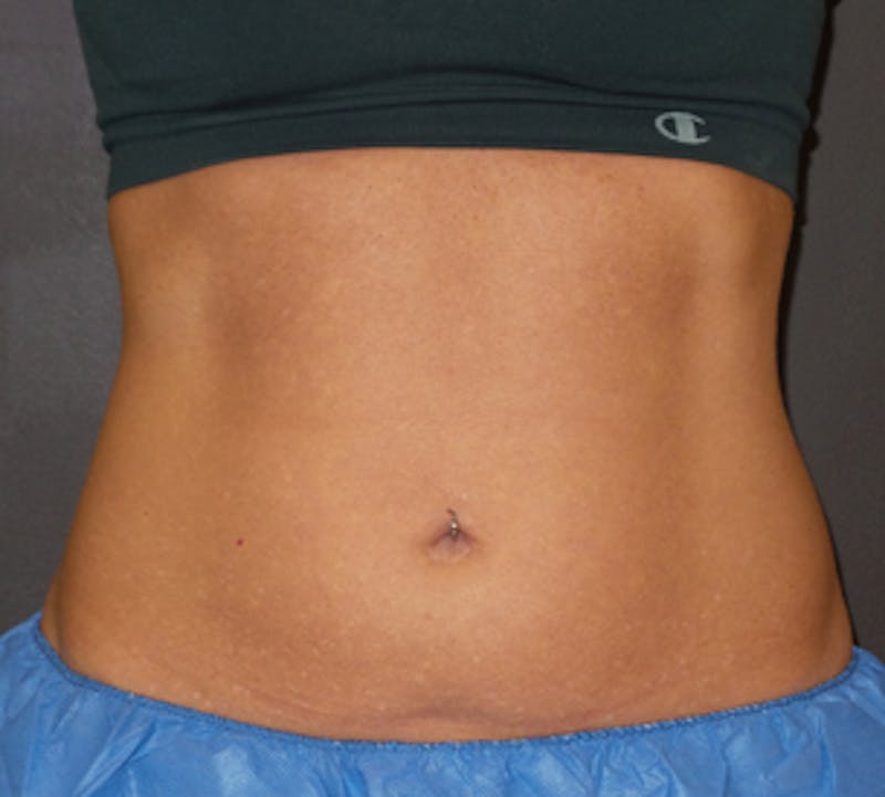 CoolSculpting® Before & After Gallery - Patient 117645936 - Image 5