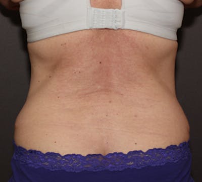 CoolSculpting® Before & After Gallery - Patient 117645937 - Image 1