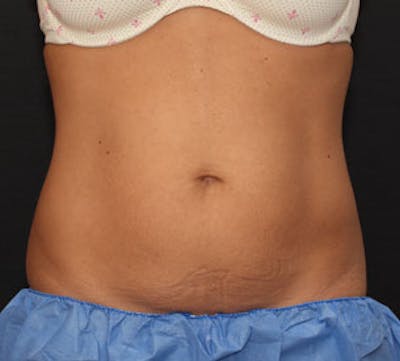 CoolSculpting® Before & After Gallery - Patient 117645939 - Image 1