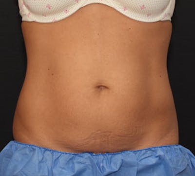 CoolSculpting® Gallery - Patient 117645939 - Image 1