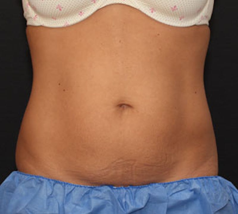 CoolSculpting® Before & After Gallery - Patient 117645939 - Image 1