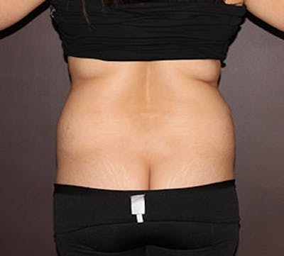 Liposuction Before & After Gallery - Patient 117645942 - Image 1