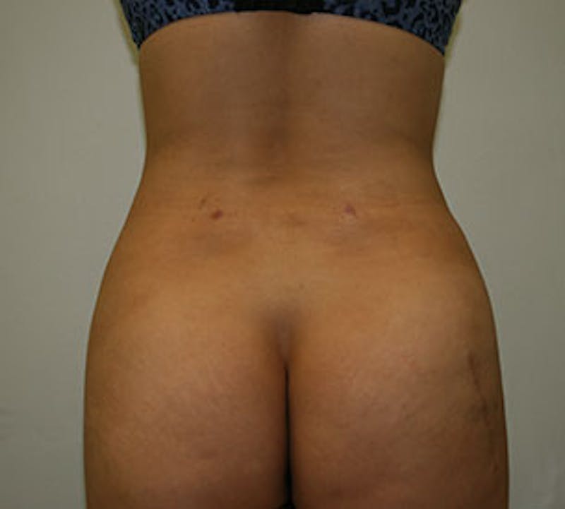 Liposuction Before & After Gallery - Patient 117645943 - Image 2