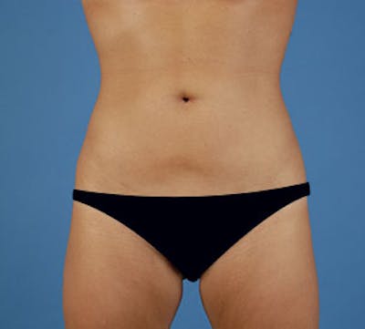 Liposuction Gallery - Patient 117645944 - Image 2