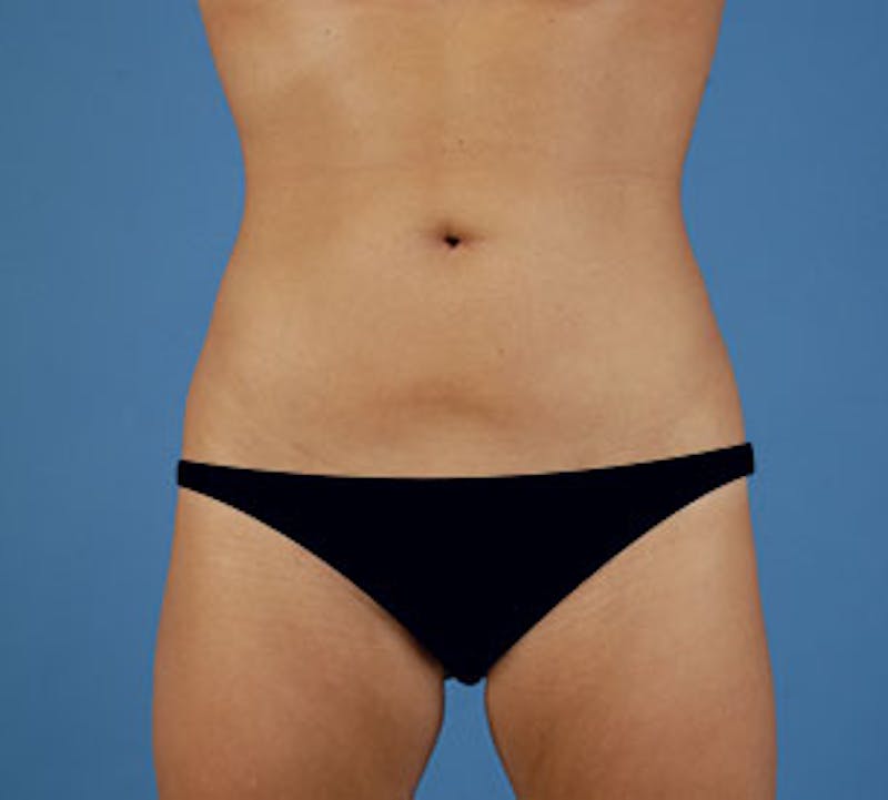 Liposuction Before & After Gallery - Patient 117645944 - Image 2