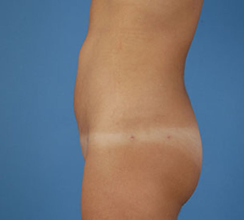 Liposuction Before & After Gallery - Patient 117645944 - Image 6