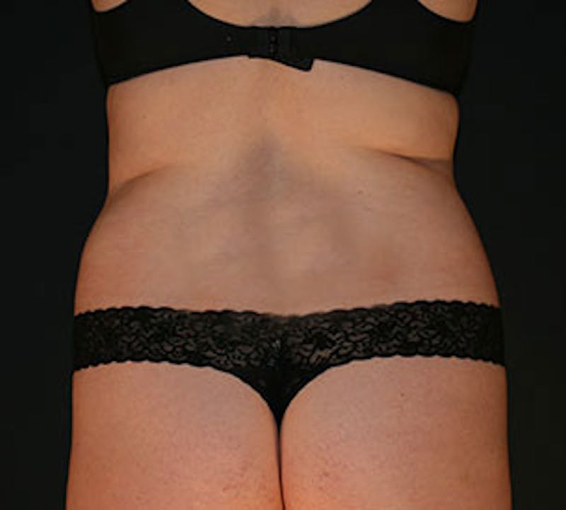 Liposuction Before & After Gallery - Patient 117645946 - Image 1