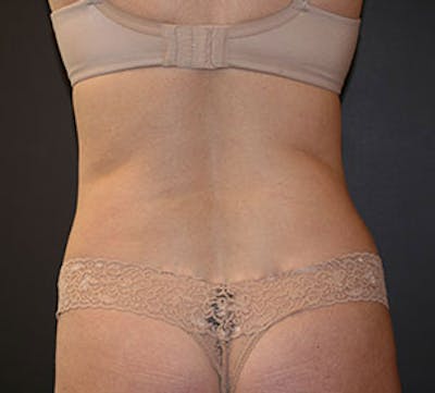 Liposuction Before & After Gallery - Patient 117645946 - Image 2