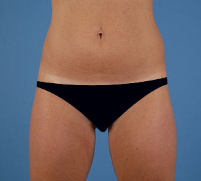 Liposuction Before & After Gallery - Patient 117645947 - Image 1