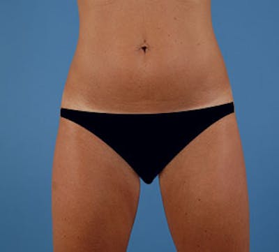 Liposuction Before & After Gallery - Patient 117645947 - Image 2