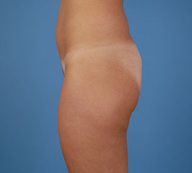 Liposuction Before & After Gallery - Patient 117645947 - Image 5