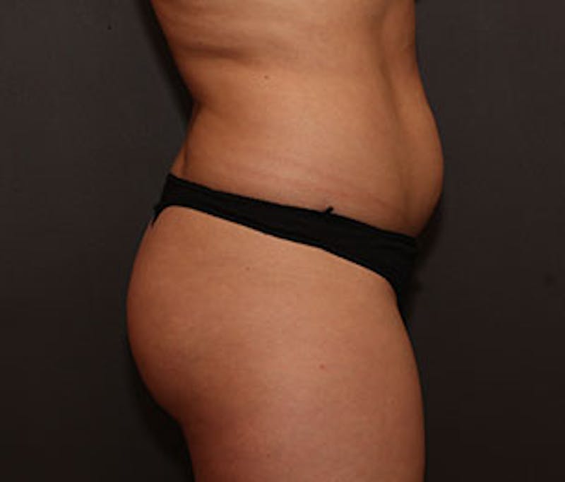 Brazilian Butt Lift Before & After Gallery - Patient 117645950 - Image 5