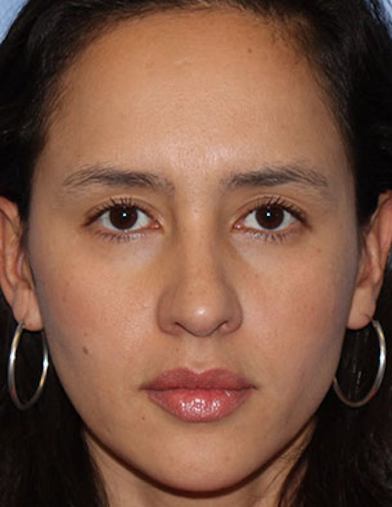 BOTOX® Before & After Gallery - Patient 117645955 - Image 1