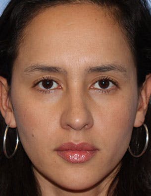BOTOX