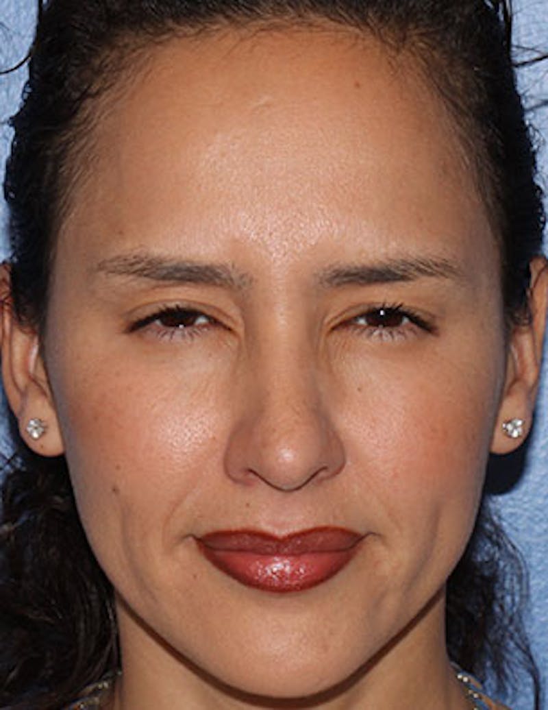 BOTOX® Before & After Gallery - Patient 117645955 - Image 8