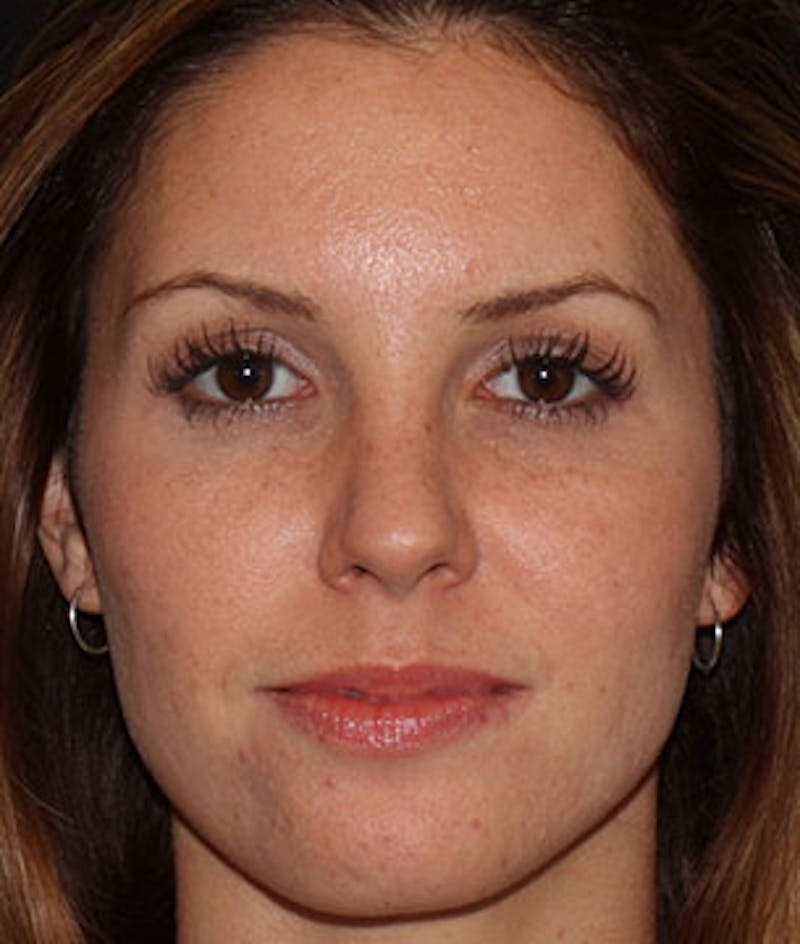 BOTOX® Before & After Gallery - Patient 117645956 - Image 2