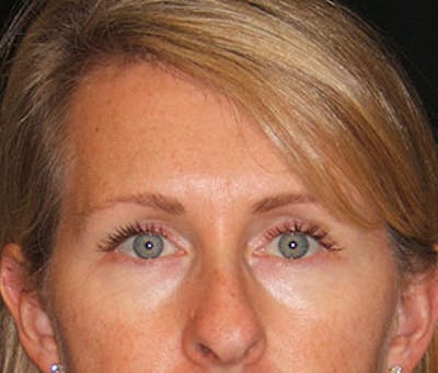 BOTOX® Before & After Gallery - Patient 117645958 - Image 1