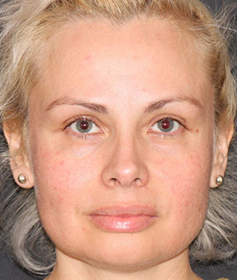BOTOX® Before & After Gallery - Patient 117645959 - Image 1