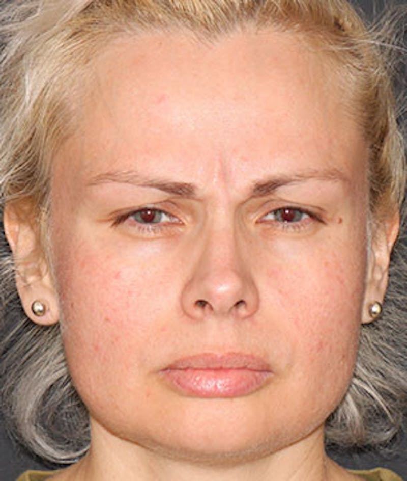 BOTOX® Before & After Gallery - Patient 117645959 - Image 3