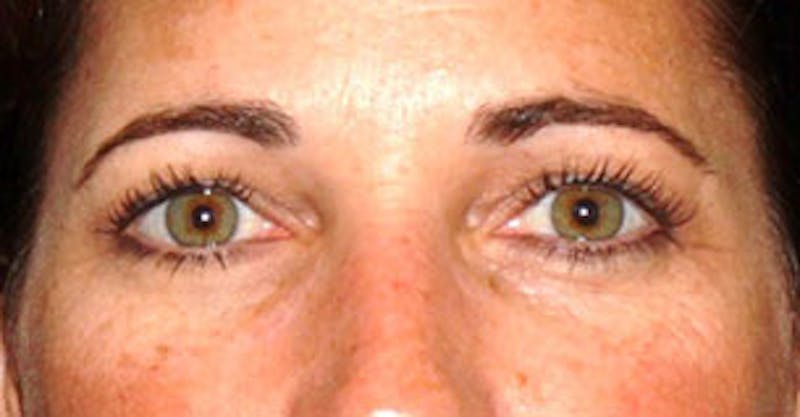 BOTOX® Before & After Gallery - Patient 117645960 - Image 1