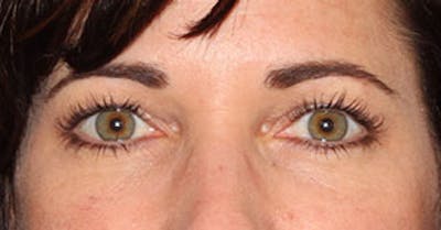 BOTOX® Before & After Gallery - Patient 117645960 - Image 2