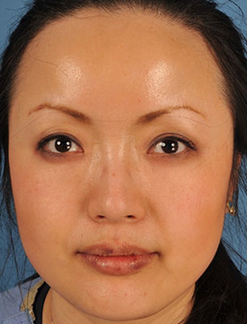 BOTOX® Before & After Gallery - Patient 117645961 - Image 1