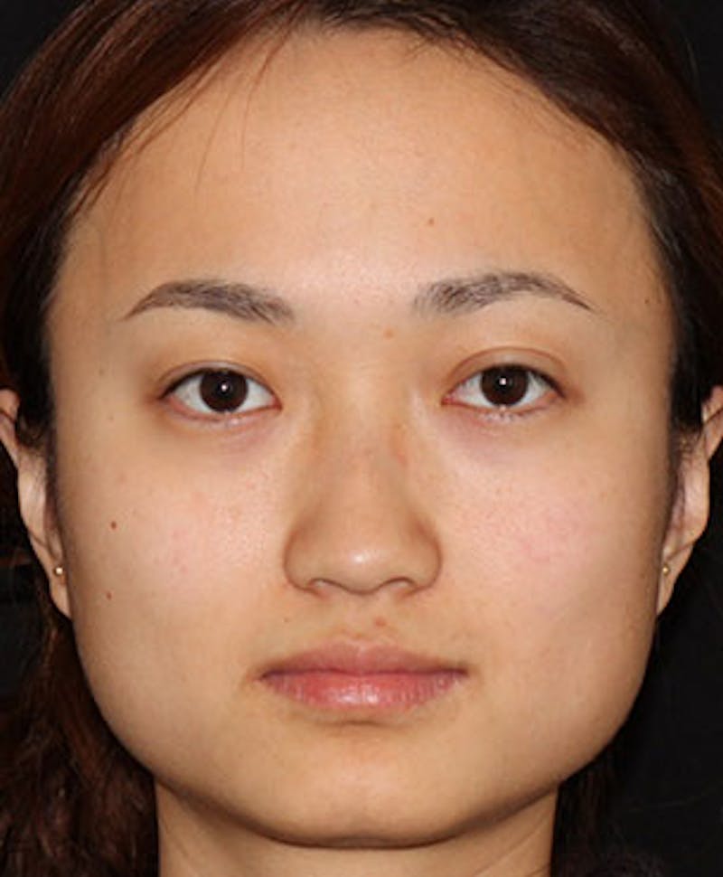 BOTOX® Before & After Gallery - Patient 117645963 - Image 1