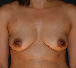 Breast Reconstruction