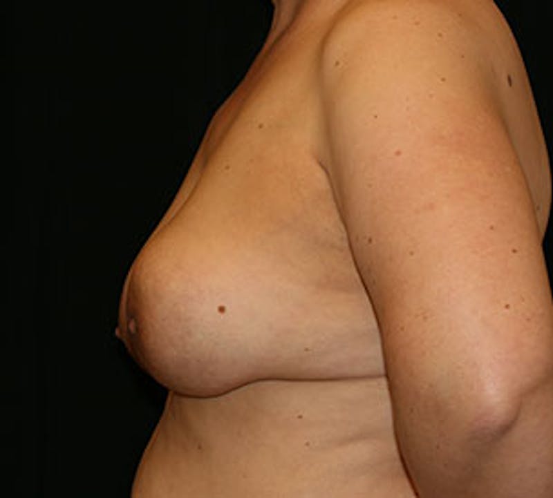 Breast Reconstruction Before & After Gallery - Patient 117645978 - Image 9
